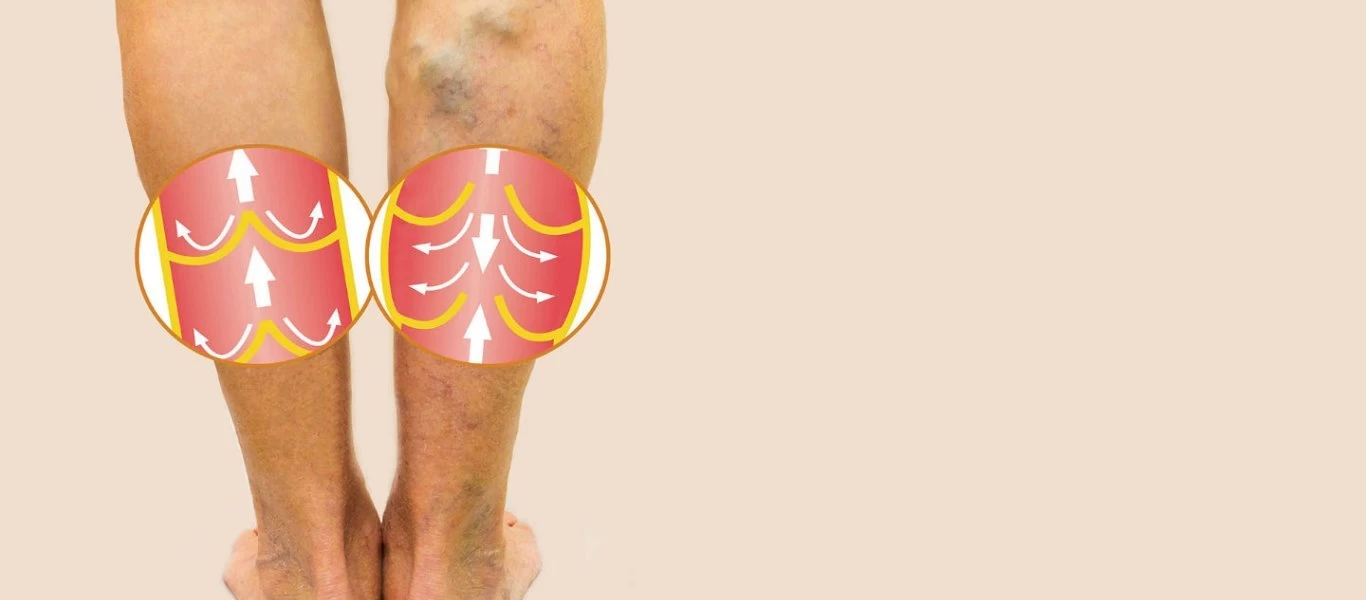 Φλεβική θρόμβωση: Συμπτώματα και ποιοι κινδυνεύουν περισσότερο